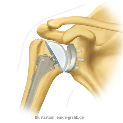 Shoulder joint prothesis